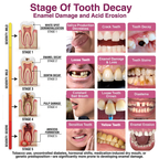 🇺🇸Rolimey® DenPerm Cavity-Repair Natural Enamel Filling Gel