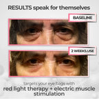 RevitalEyes® 2-in-1 Red Light Therapy + EMS Device, No Battery