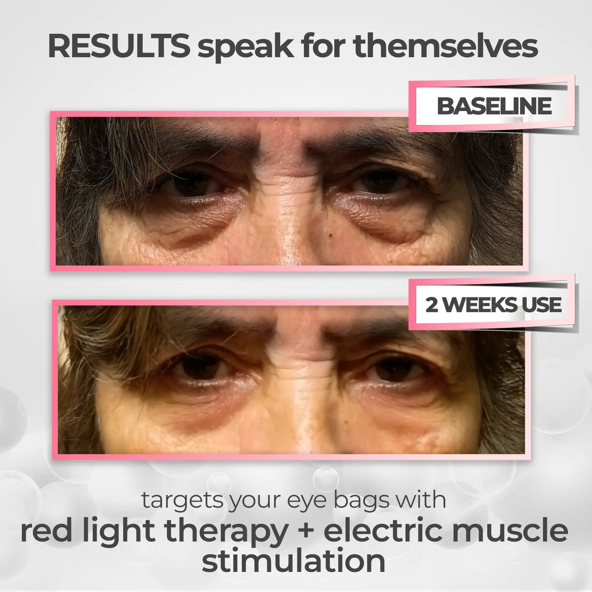 RevitalEyes® 2-in-1 Red Light Therapy + EMS Device, No Battery